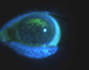 Confluent Dry Eye Staining